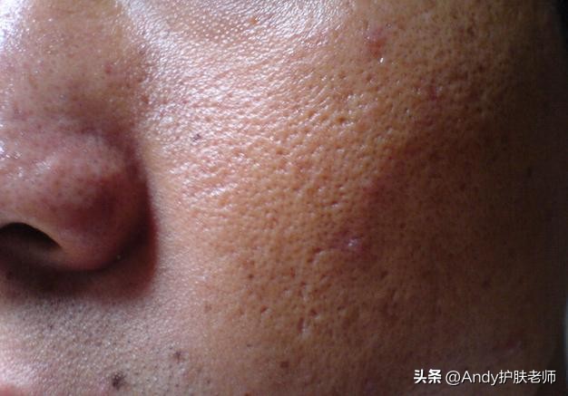 男人出油旺盛：明显的3大表现！
1.皮肤油腻，整天油