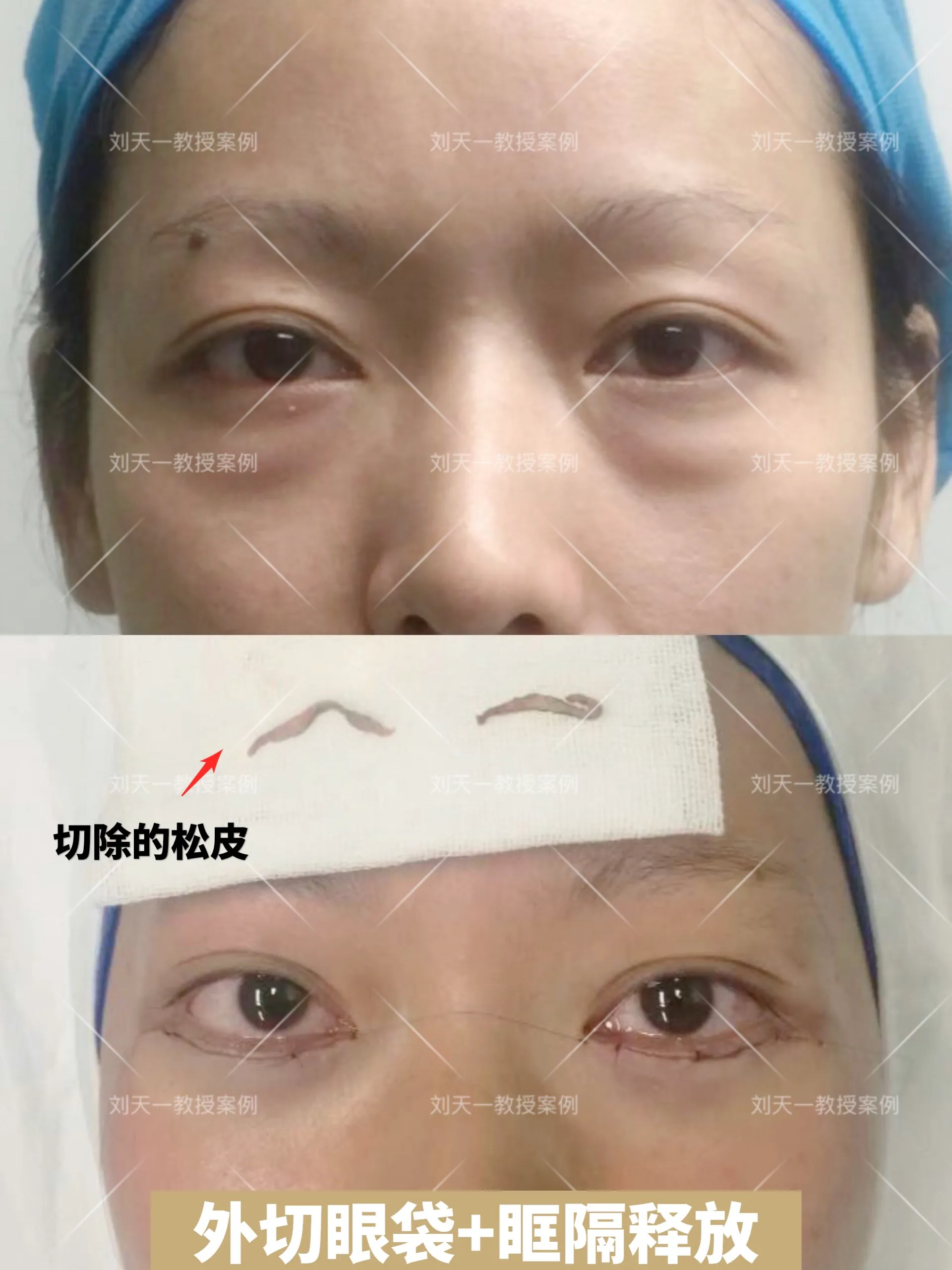 外切眼袋+眶隔释放术后即刻 年龄不大的一位病人，大眼袋清晰可见，