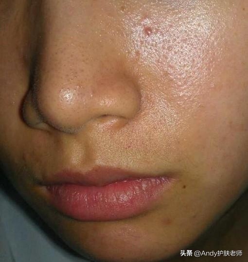男人出油旺盛：典型的3大特征！
1.皮肤油腻，整天油